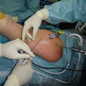 Cirugía Artroscópica en Guadalajara